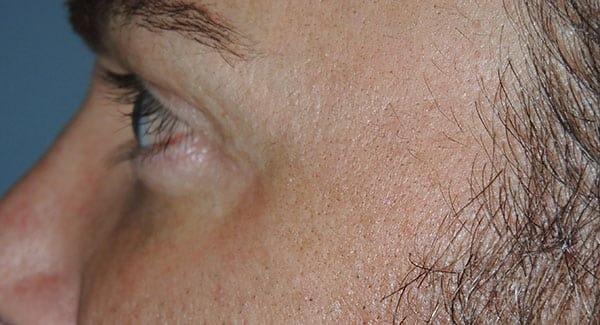 Jawline Filler after at Arkansas Oculoplastic Surgery, PLLC: Brock Wade D MD in Little Rock, AR