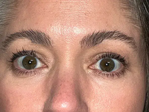 Blepharoplasty after at Arkansas Oculoplastic Surgery, PLLC: Brock Wade D MD in Little Rock, AR