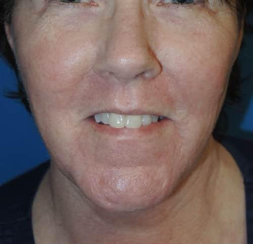 Laser Skin Resurfacing after at Arkansas Oculoplastic Surgery, PLLC: Brock Wade D MD in Little Rock, AR