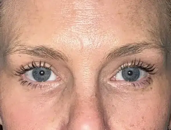 Blepharoplasty after at Arkansas Oculoplastic Surgery, PLLC: Brock Wade D MD in Little Rock, AR