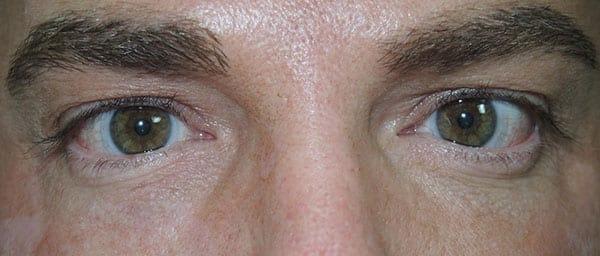 Dermal Fillers after at Arkansas Oculoplastic Surgery, PLLC: Brock Wade D MD in Little Rock, AR