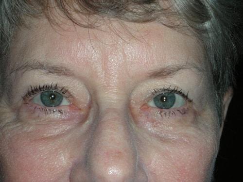 Blepharoplasty after at Arkansas Oculoplastic Surgery, PLLC: Brock Wade D MD in Little Rock, AR