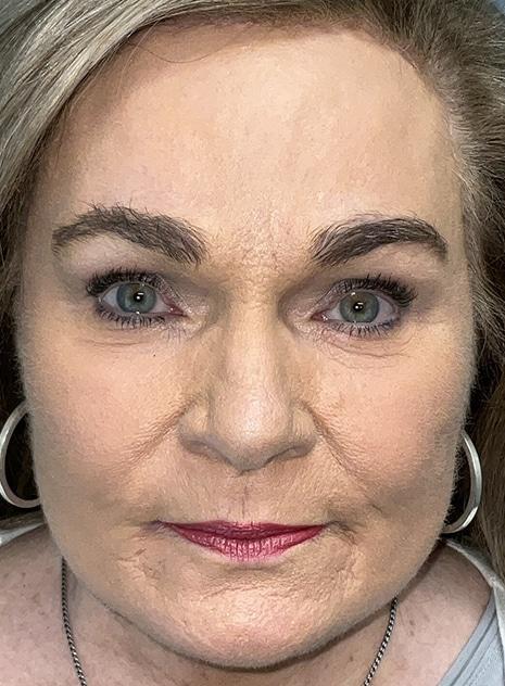 Brow Lift after at Arkansas Oculoplastic Surgery, PLLC: Brock Wade D MD in Little Rock, AR