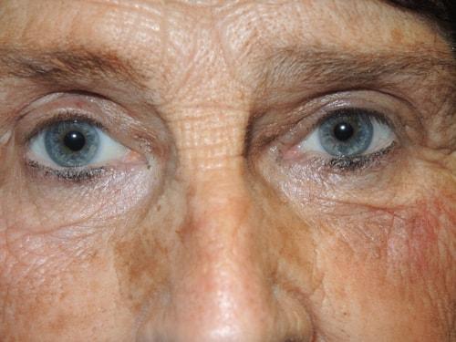 Blepharoplasty after at Arkansas Oculoplastic Surgery, PLLC: Brock Wade D MD in Little Rock, AR