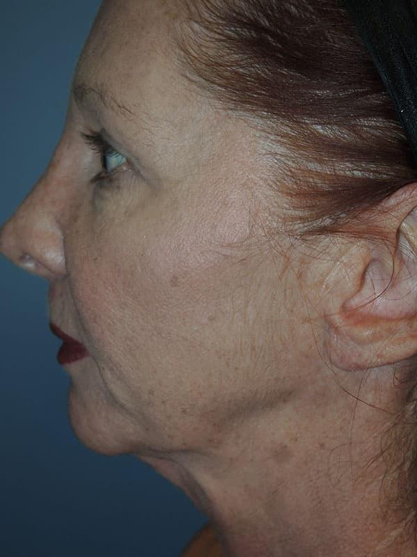 Deep Plane Facelift before at Arkansas Oculoplastic Surgery, PLLC: Brock Wade D MD in Little Rock, AR