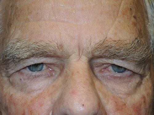 Blepharoplasty before at Arkansas Oculoplastic Surgery, PLLC: Brock Wade D MD in Little Rock, AR