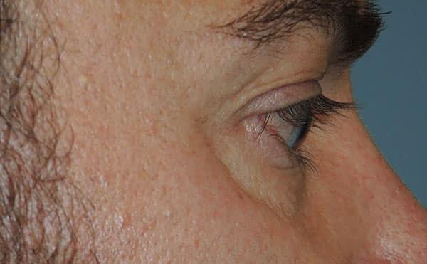 Jawline Filler before at Arkansas Oculoplastic Surgery, PLLC: Brock Wade D MD in Little Rock, AR