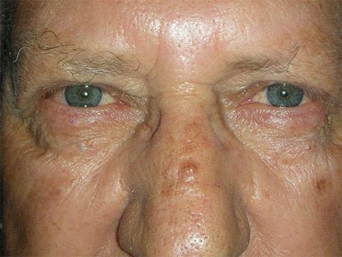 Blepharoplasty after at Arkansas Oculoplastic Surgery, PLLC: Brock Wade D MD in Little Rock, AR