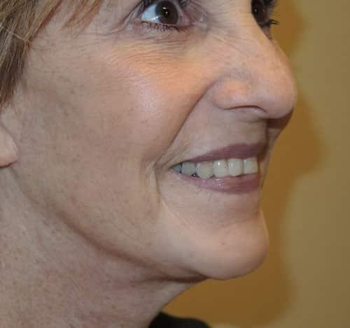 Deep Plane Facelift after at Arkansas Oculoplastic Surgery, PLLC: Brock Wade D MD in Little Rock, AR
