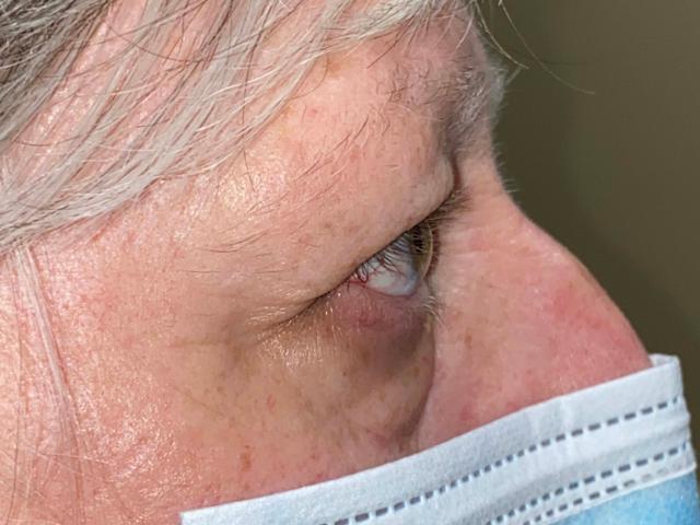 Blepharoplasty before at Arkansas Oculoplastic Surgery, PLLC: Brock Wade D MD in Little Rock, AR