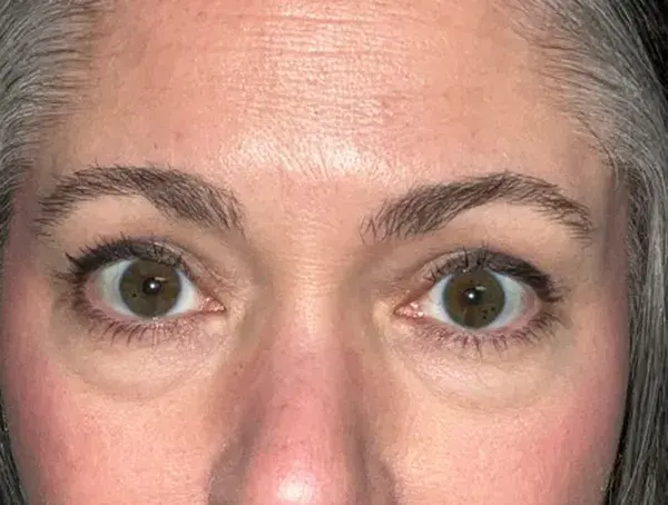 Blepharoplasty before at Arkansas Oculoplastic Surgery, PLLC: Brock Wade D MD in Little Rock, AR