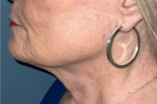 Deep Plane Facelift before at Arkansas Oculoplastic Surgery, PLLC: Brock Wade D MD in Little Rock, AR