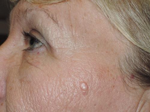Blepharoplasty after at Arkansas Oculoplastic Surgery, PLLC: Brock Wade D MD in Little Rock, AR