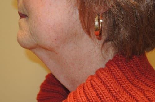 Deep Plane Facelift after at Arkansas Oculoplastic Surgery, PLLC: Brock Wade D MD in Little Rock, AR