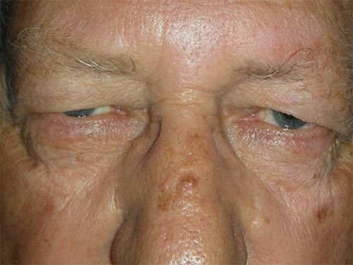 Blepharoplasty before at Arkansas Oculoplastic Surgery, PLLC: Brock Wade D MD in Little Rock, AR