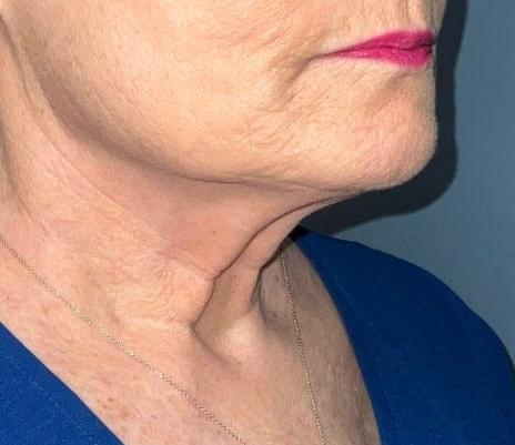 Deep Plane Facelift before at Arkansas Oculoplastic Surgery, PLLC: Brock Wade D MD in Little Rock, AR