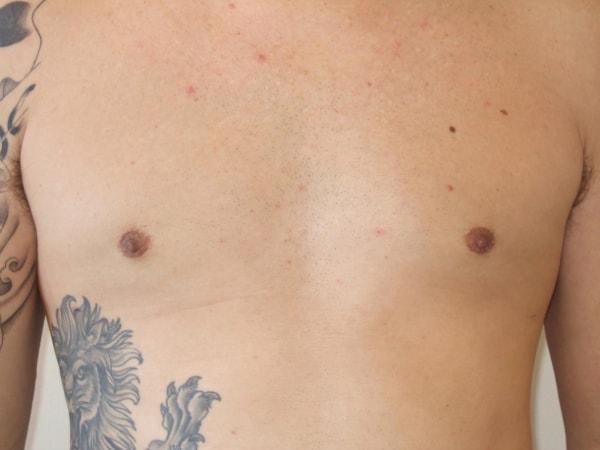 Gynecomastia Surgery after at Bay Area Plastic Surgery (Leonard W. Gray, MD) in San Francisco, CA