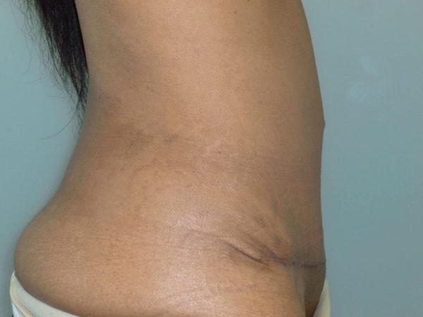 Bay Area Plastic Surgery (Leonard W. Gray, MD) tummy tuck after — San Francisco, CA