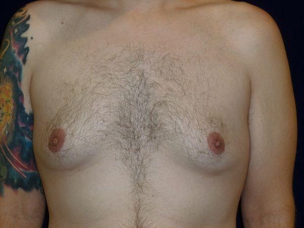 Gynecomastia Surgery before at Bay Area Plastic Surgery (Leonard W. Gray, MD) in San Francisco, CA