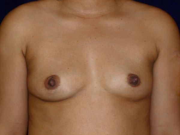 Breast Augmentation before at Bay Area Plastic Surgery (Leonard W. Gray, MD) in San Francisco, CA
