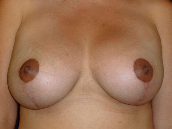 Breast Lift after at Bay Area Plastic Surgery (Leonard W. Gray, MD) in San Francisco, CA
