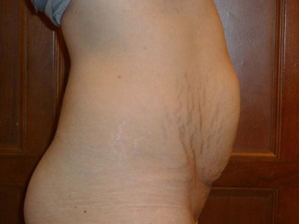 Mini Tummy Tuck before at Bay Area Plastic Surgery (Leonard W. Gray, MD) in San Francisco, CA