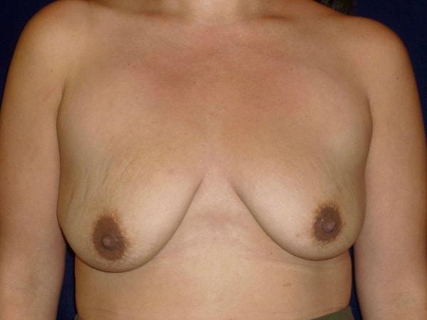 Breast Lift before at Bay Area Plastic Surgery (Leonard W. Gray, MD) in San Francisco, CA