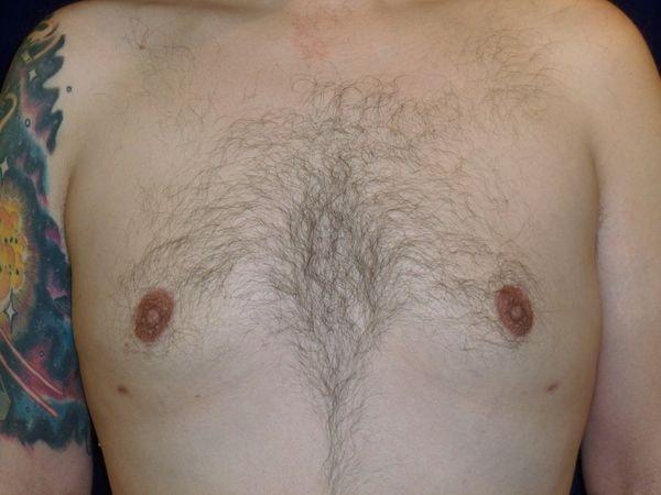 Gynecomastia Surgery after at Bay Area Plastic Surgery (Leonard W. Gray, MD) in San Francisco, CA