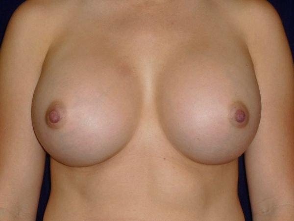 Bay Area Plastic Surgery (Leonard W. Gray, MD) breast augmentation revision after — San Francisco, CA