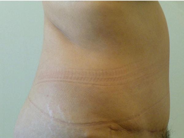 Bay Area Plastic Surgery (Leonard W. Gray, MD) tummy tuck after — San Francisco, CA