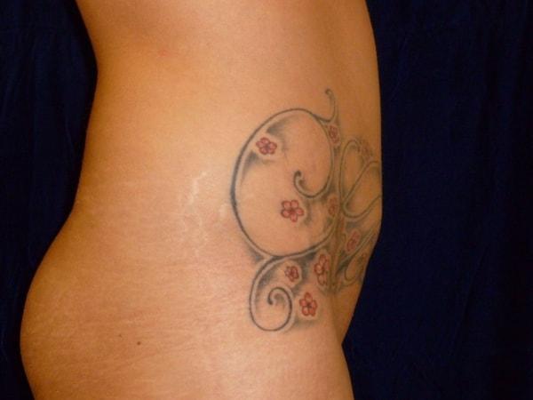 Bay Area Plastic Surgery (Leonard W. Gray, MD) tummy tuck after — San Francisco, CA
