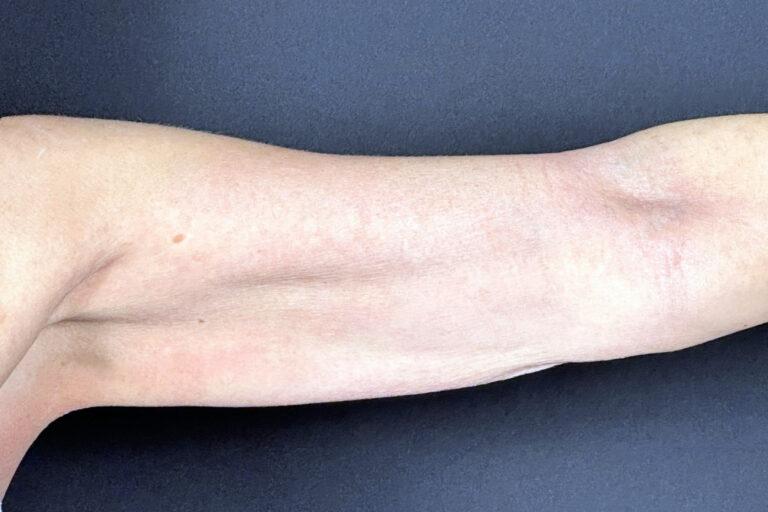 Elinea on 18th & Noe microneedling after — San Francisco, CA