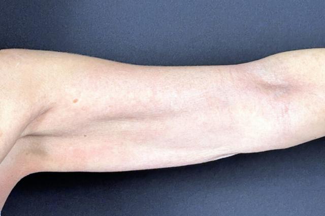 Microneedling after at Elinea on 18th & Noe in San Francisco, CA