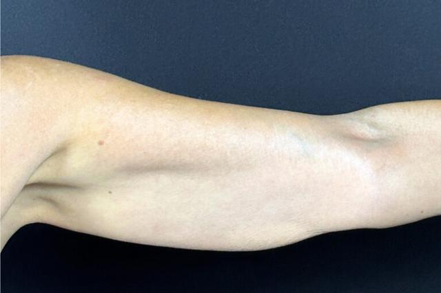 Microneedling before at Elinea on 18th & Noe in San Francisco, CA