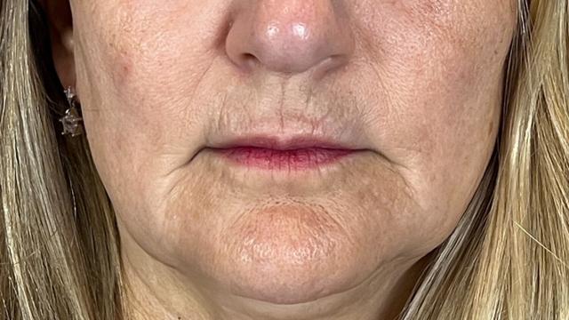 Laser Skin Resurfacing before at Elinea on 18th & Noe in San Francisco, CA