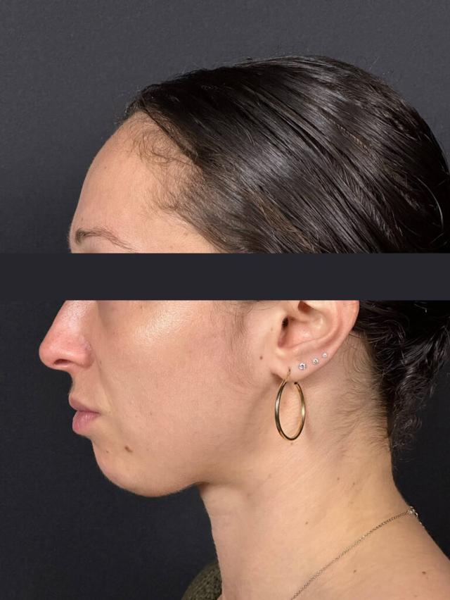 Rhinoplasty before at Elinea on 18th & Noe in San Francisco, CA