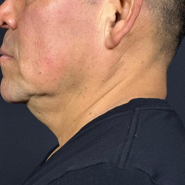 Elinea on 18th & Noe microneedling after — San Francisco, CA