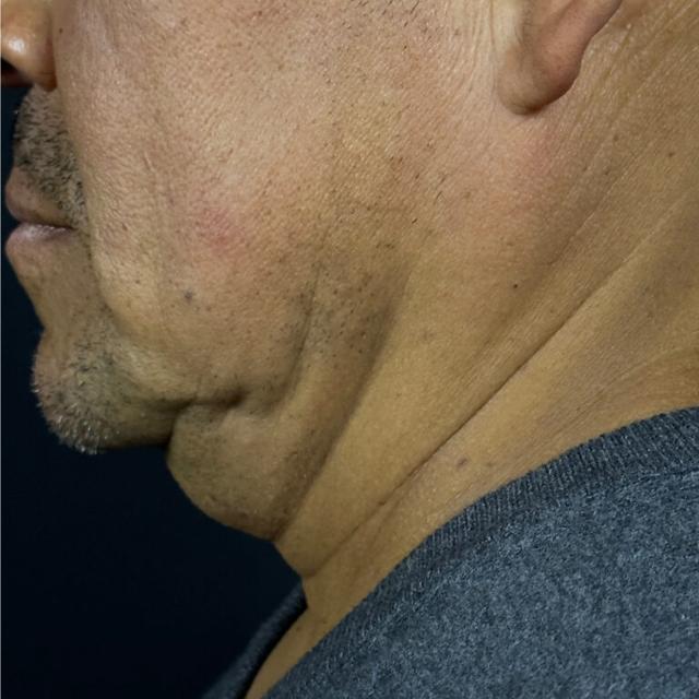 Microneedling before at Elinea on 18th & Noe in San Francisco, CA