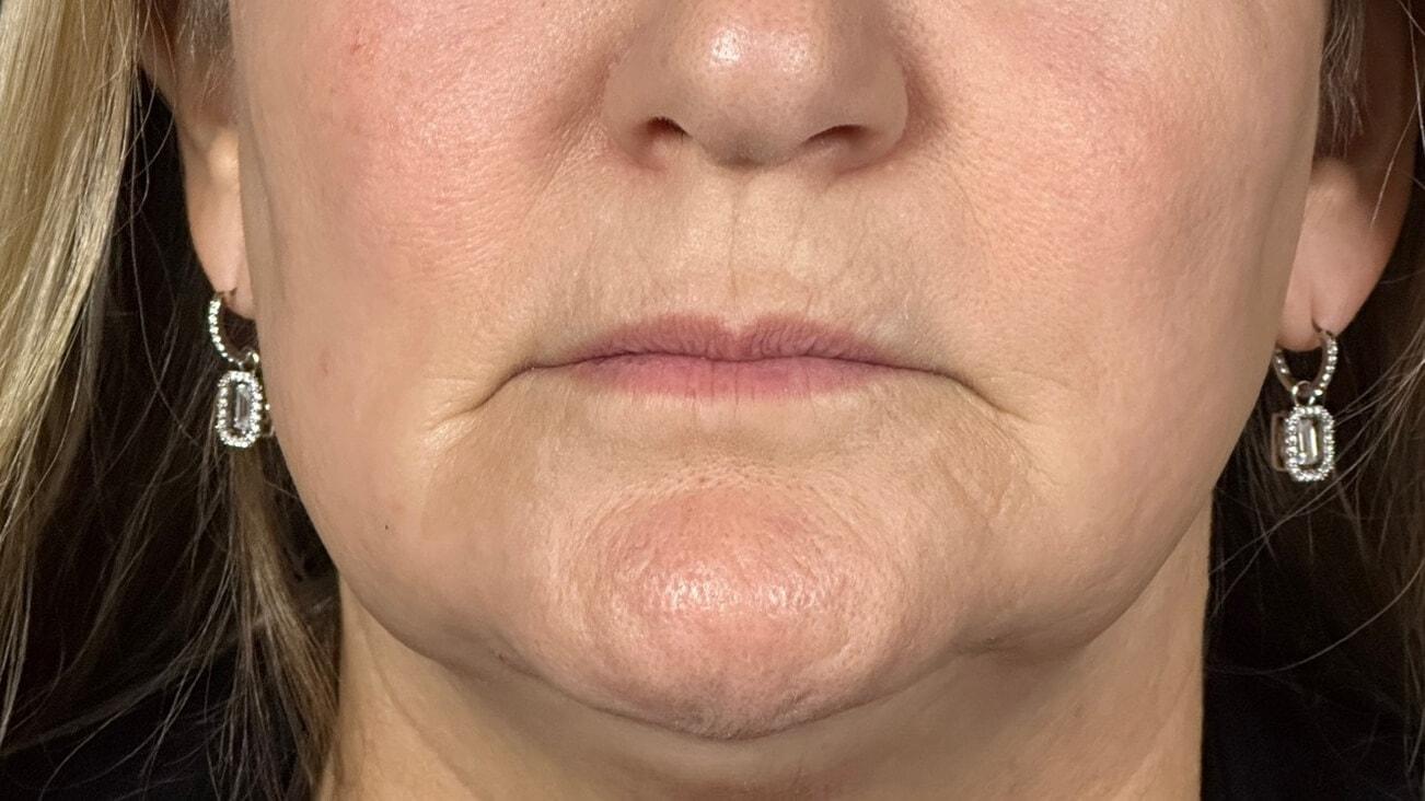 Elinea on 18th & Noe laser treatment after — San Francisco, CA