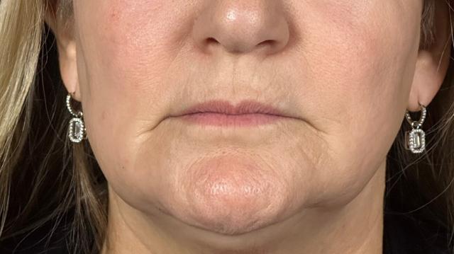 Laser Skin Resurfacing after at Elinea on 18th & Noe in San Francisco, CA