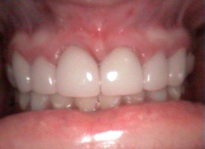 Arbor Dental Cedar veneers after — Cedar City, UT