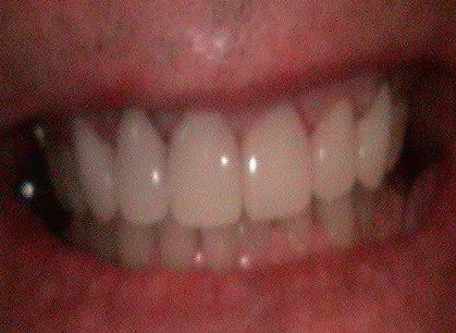 Arbor Dental Cedar veneers after — Cedar City, UT