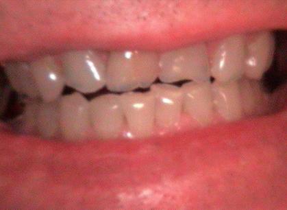 Dental Veneers before at Arbor Dental Cedar in Cedar City, UT