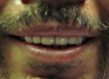 Dental Veneers after at Arbor Dental Cedar in Cedar City, UT