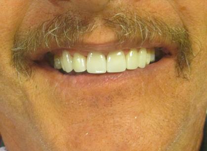 Arbor Dental Cedar veneers after — Cedar City, UT