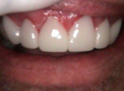 Arbor Dental Cedar veneers after — Cedar City, UT