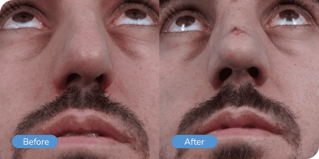 Rhinoplasty result at Ward MD Plastic Surgery in Salt Lake City, UT