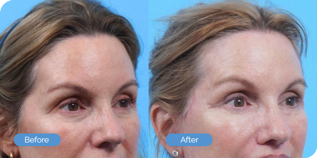 Ward MD Plastic Surgery blepharoplasty result — Salt Lake City, UT