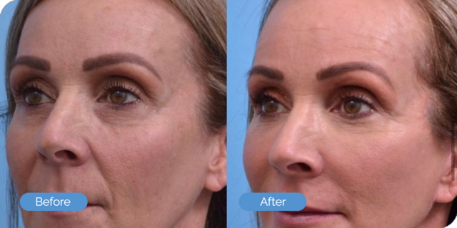 Blepharoplasty result at Ward MD Plastic Surgery in Salt Lake City, UT