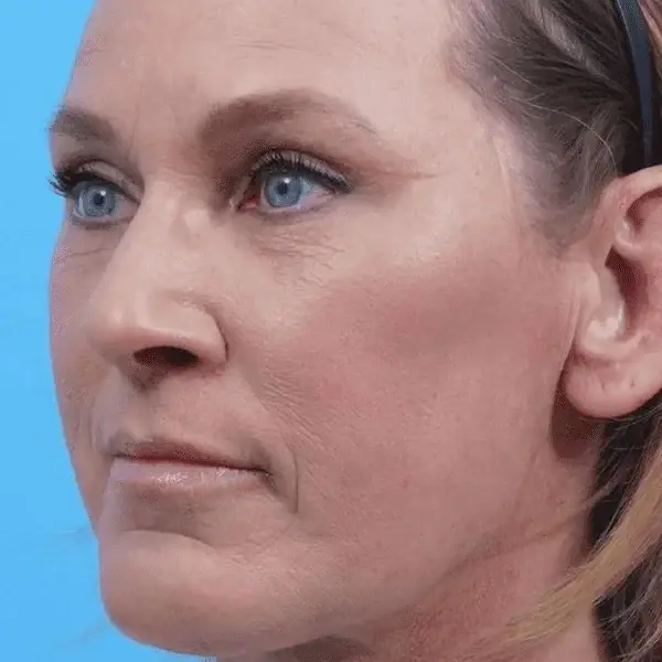 Ward MD Plastic Surgery facelift after — Salt Lake City, UT